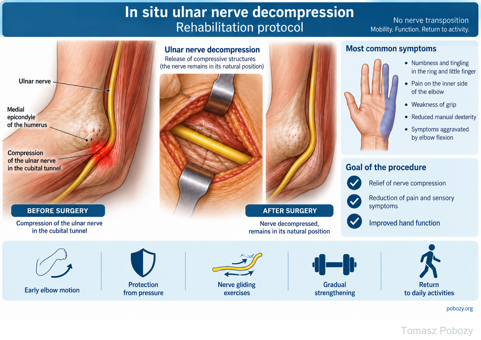 In situ ulnar nerve decompression without transposition — nerve compression, surgical release and rehabilitation stages · board 1/1. Prepared by Tomasz Poboży — orthopaedic surgeon.