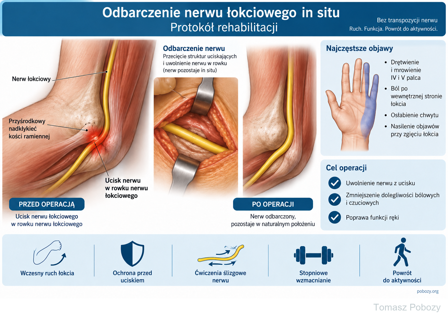 Odbarczenie nerwu łokciowego in situ bez transpozycji — ucisk nerwu, odbarczenie i etapy rehabilitacji · plansza 1/1. Opracował Tomasz Poboży — ortopeda.