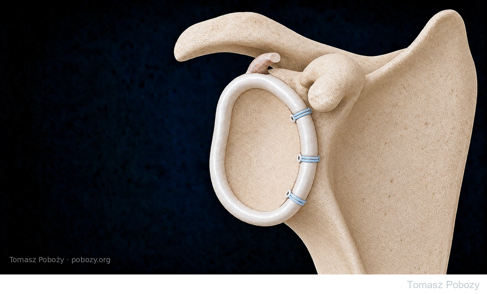 Postoperative rehabilitation: Diagram of Bankart repair with the shoulder labrum fixed using suture anchors. Prepared by Tomasz Poboży — orthopaedic surgeon.